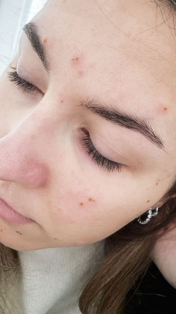 Acné adulte à 35 ans avec microkystes sur peau mixte sensible