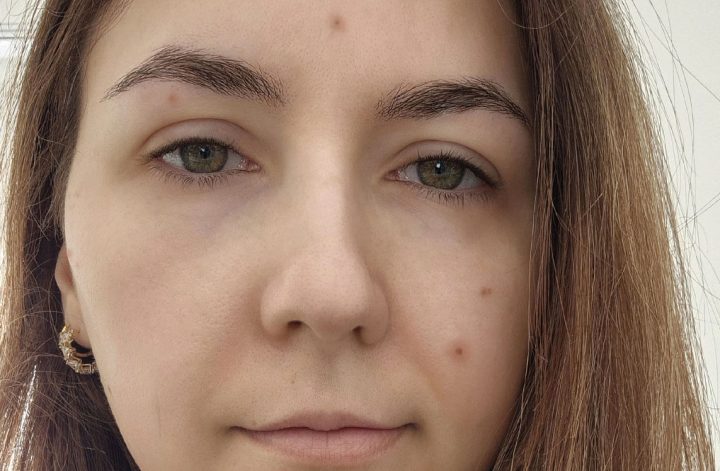 Acné adulte à 35 ans sur peau mixte sensible avec microkystes