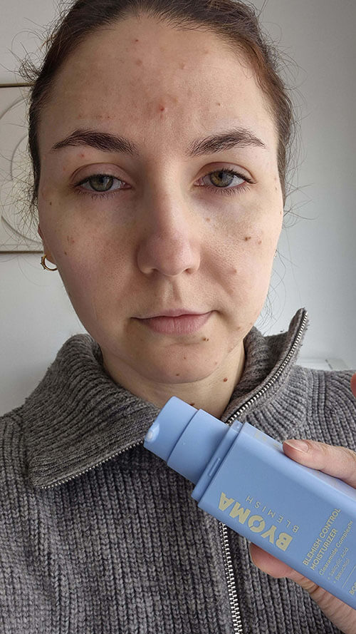 Photo avant-après du Blemish Control Byoma montrant une peau avec davantage d’imperfections après utilisation du produit.