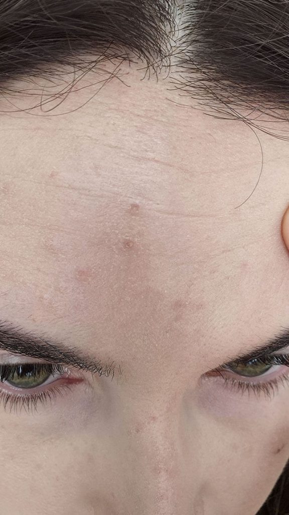 Rendu du fond de teint Haus Labs Triclone Foundation sur peau mixte avec zones de sécheresse visibles sur le front et texture cutanée marquée.