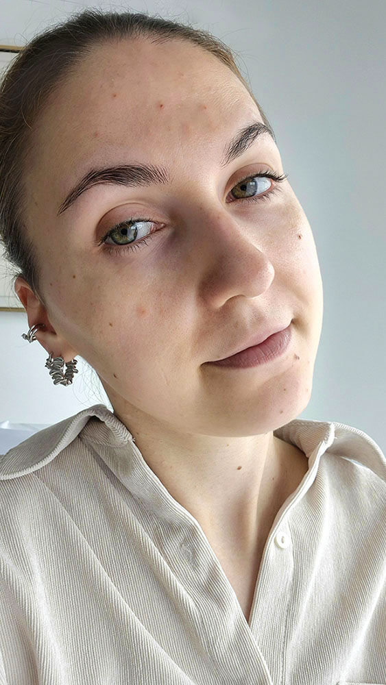Visage en gros plan après 9 mois de test de la crème La Rosée, peau apaisée et lumineuse sans bouton d'acné réactif.